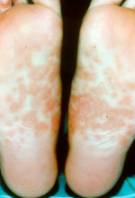 A Symptom of Syphilis